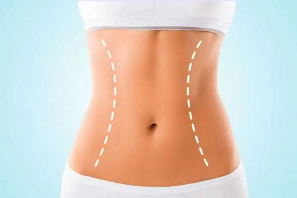 foto ilustrativa abdominosplastia