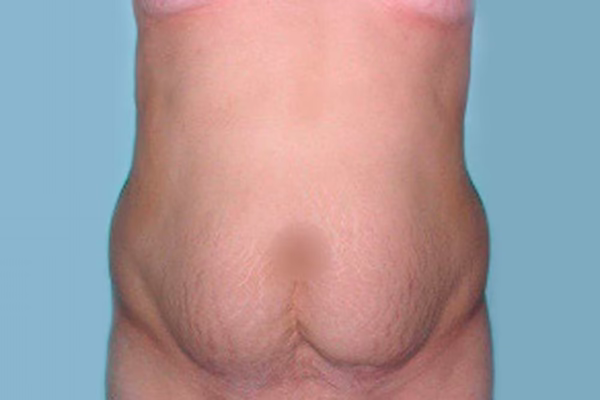 Antes - abdominoplastia