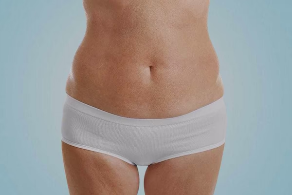 Antes - abdominoplastia