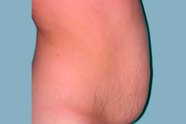 Antes - abdominoplastia