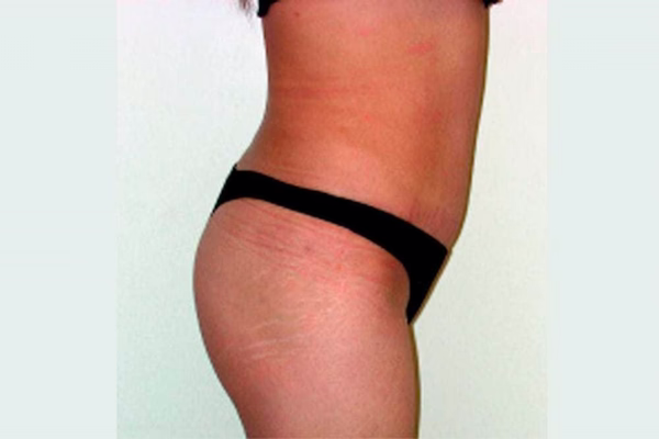 Después - abdominoplastia