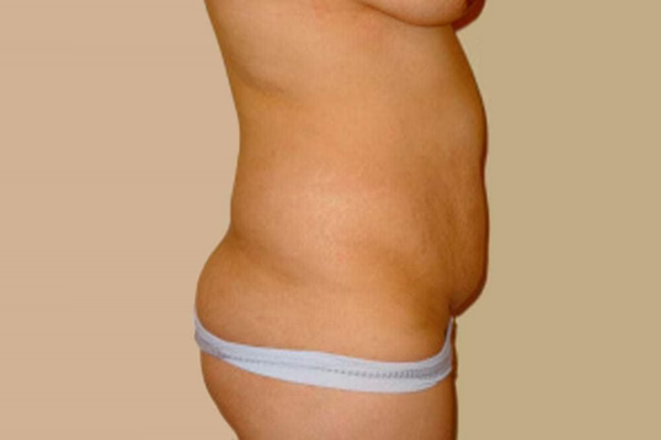 Antes - abdominoplastia