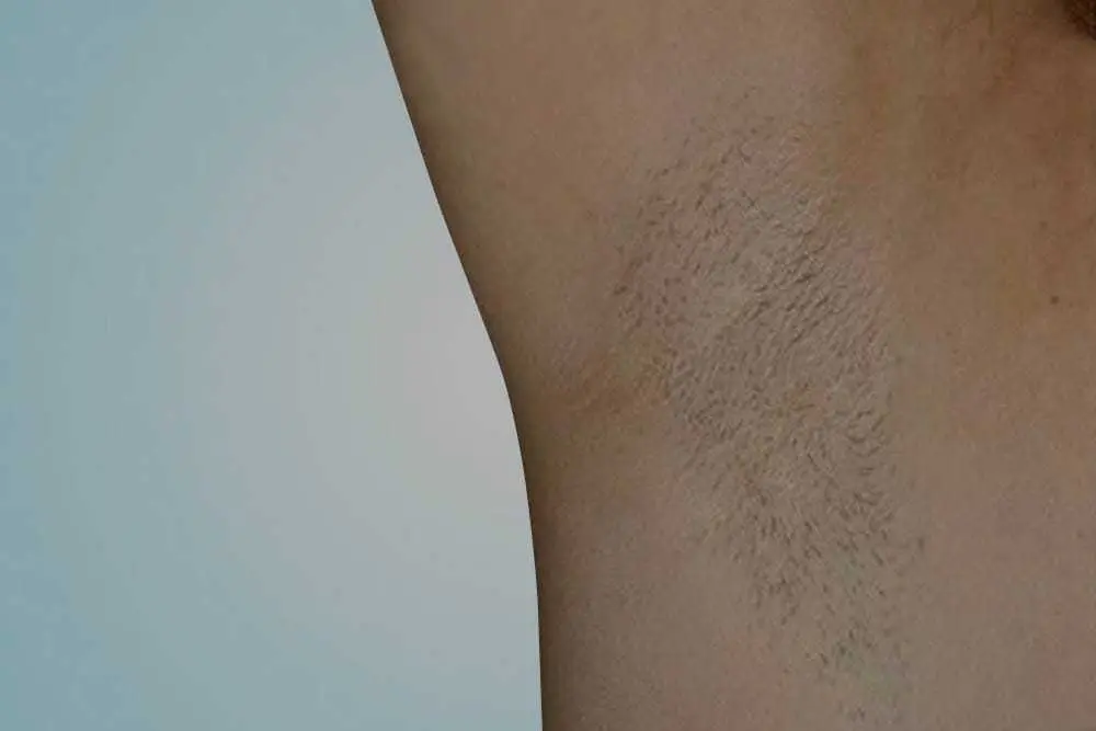 Antes - depilacion laser
