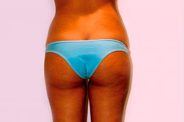 Después - lipoescultura