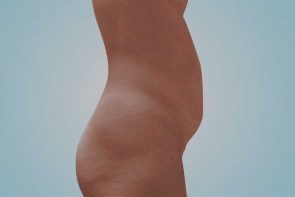 Antes - lipoescultura