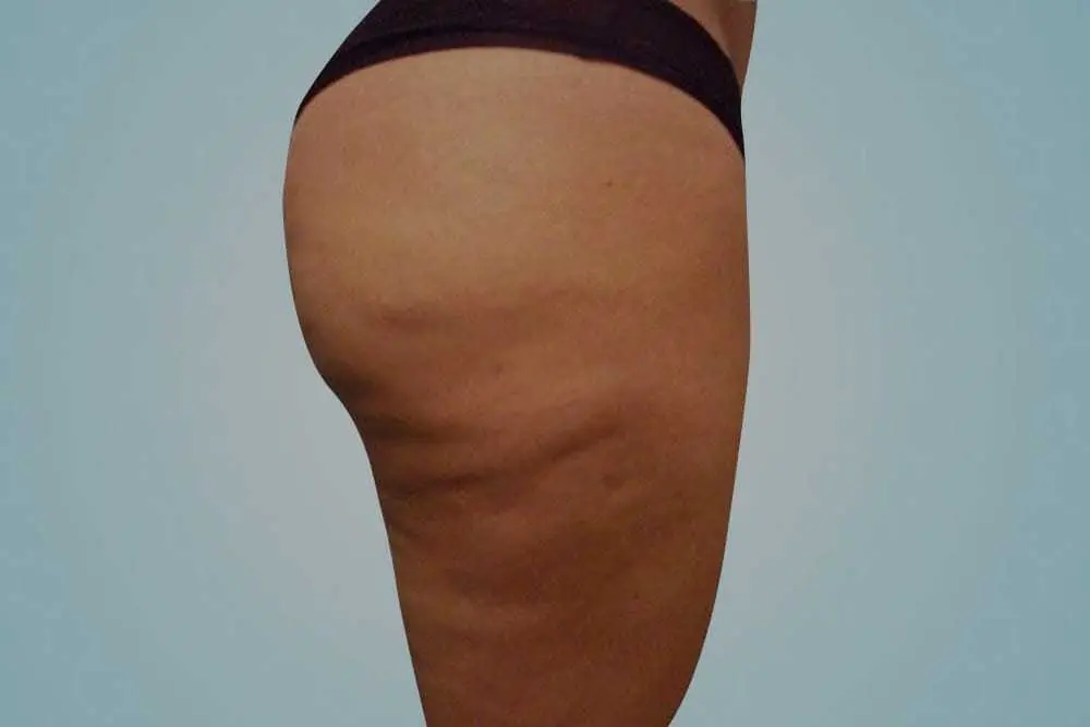 Antes - mesoterapiavirtual