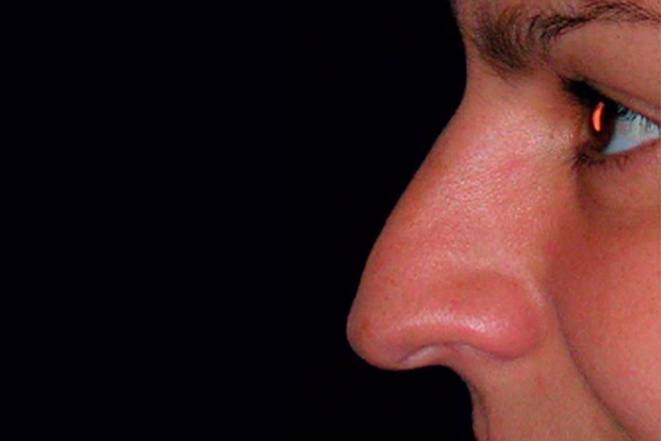 Antes - rinoplastia