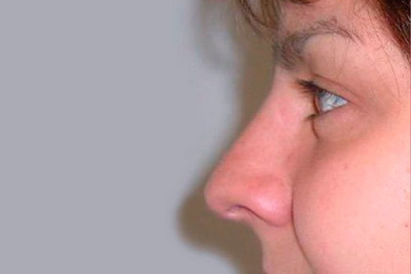 Después - rinoplastia