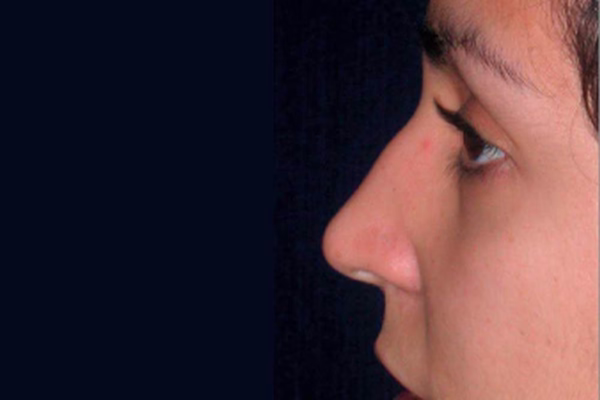 Antes - rinoplastia