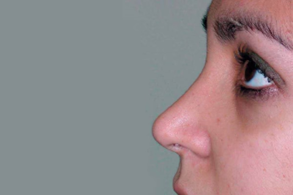 Después - rinoplastia
