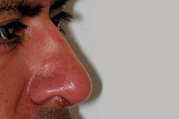 Antes - rinoplastia