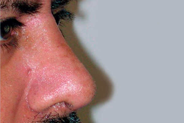 Después - rinoplastia
