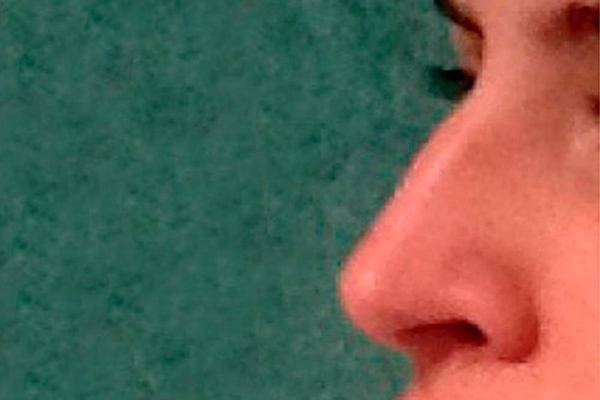 Antes - rinoplastia