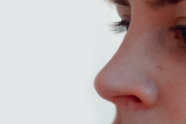 Después - rinoplastia