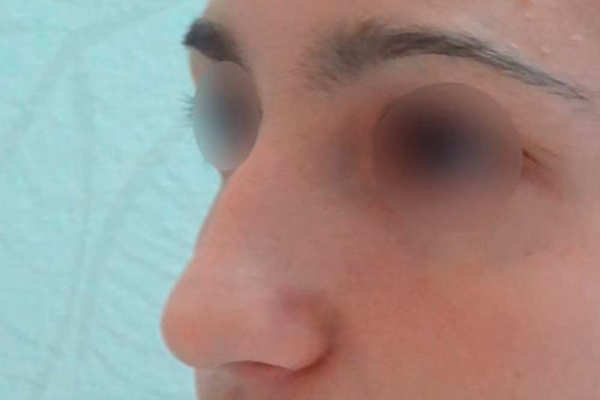 Antes - rinoplastia