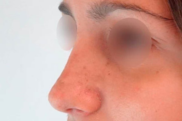 Después - rinoplastia