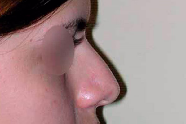 Antes - rinoplastia