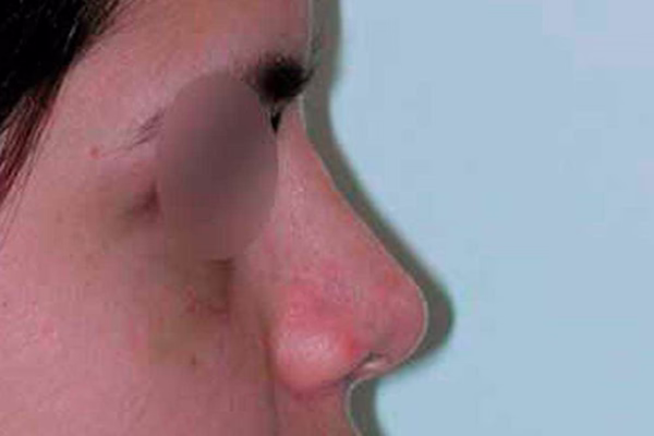 Después - rinoplastia