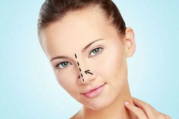 foto procedimiento de rinoplastia